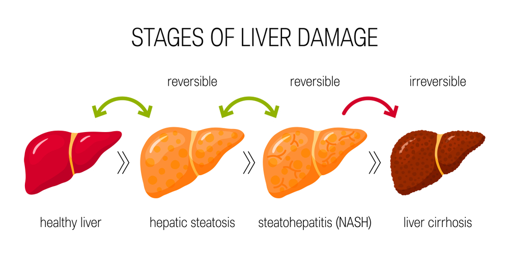 Stages of Liver Damage