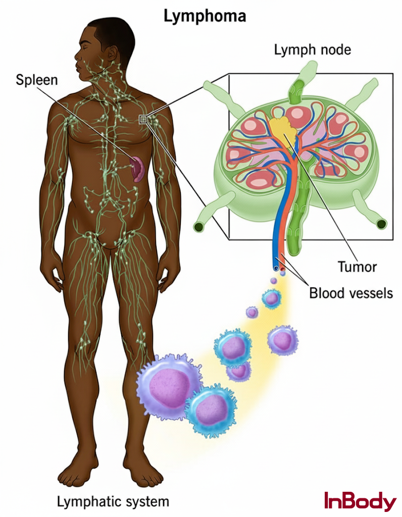Diagram showing human body outline with highlighted lymphatic system organs (lymph nodes, spleen, etc.), alongside a cellular‐close-up view of lymphoma cells.