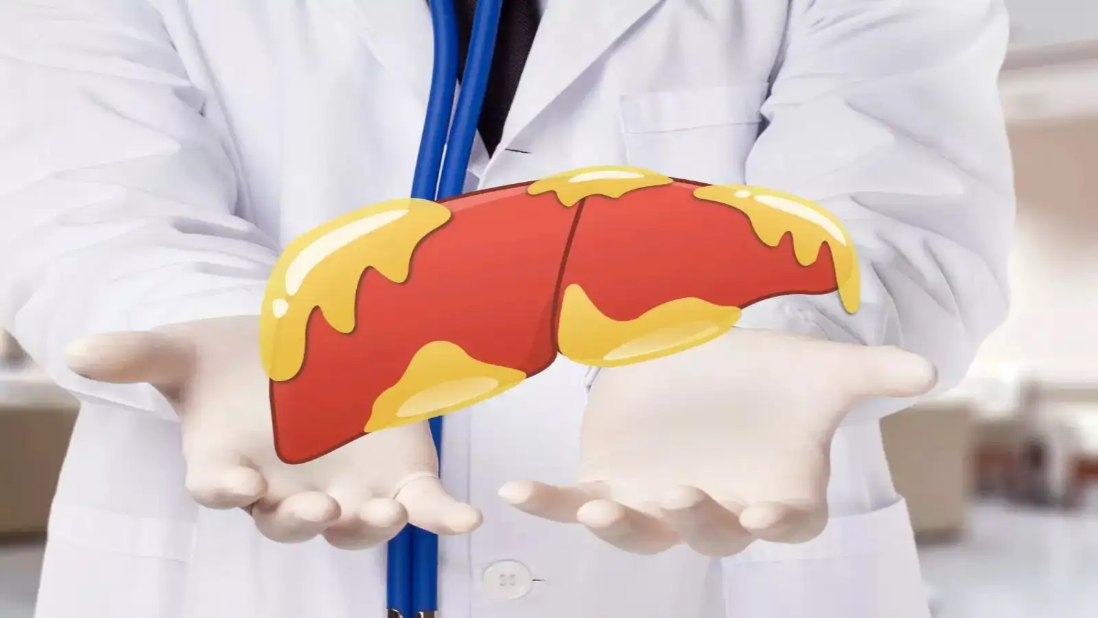 Fatty Liver and Sugar Intake: What You Need to Know