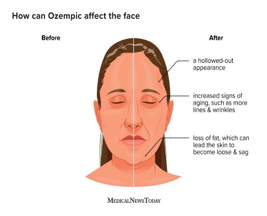 Visual demonstration of Ozempic face effect showing facial volume loss during rapid weight loss